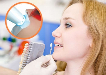 Diş Beyazlatma İşlemi Nedir ve Nasıl Yapılır?