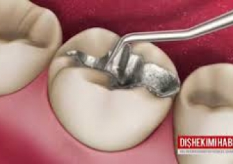 Amalgam Dolgu Nedir? Amalgam Dolgu Zararlı Mıdır?