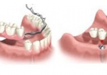 Hareketli Protez Nedir?